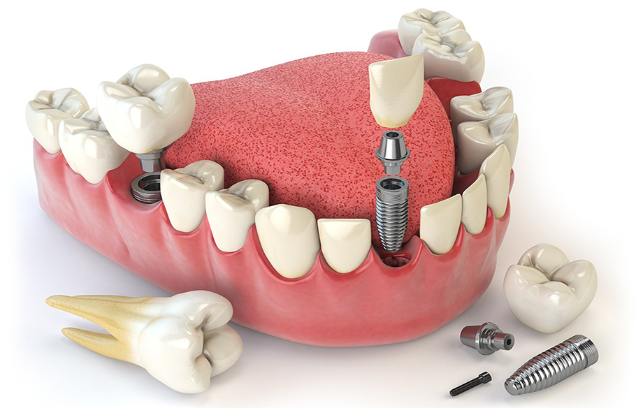 طب الأسنان التعويضي